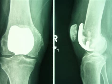 bronze kneecap|knee cap replacement surgery.